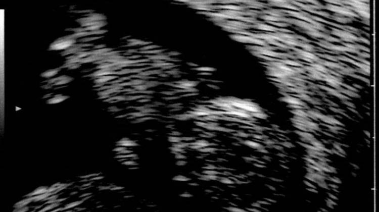 An ultrasound image.