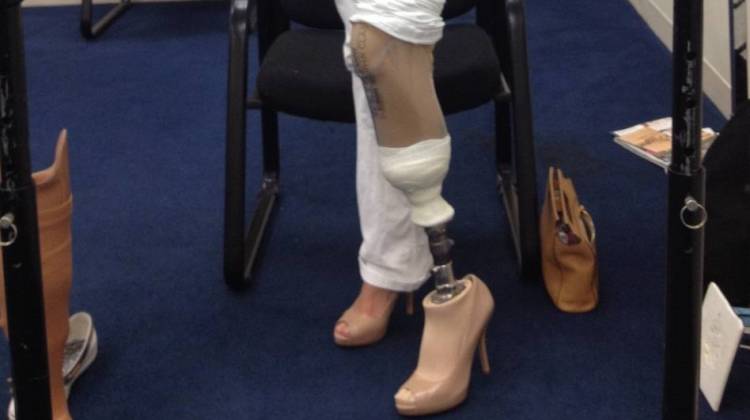 After Losing A Leg, Woman Walks On Her Own -- In 4-Inch Heels