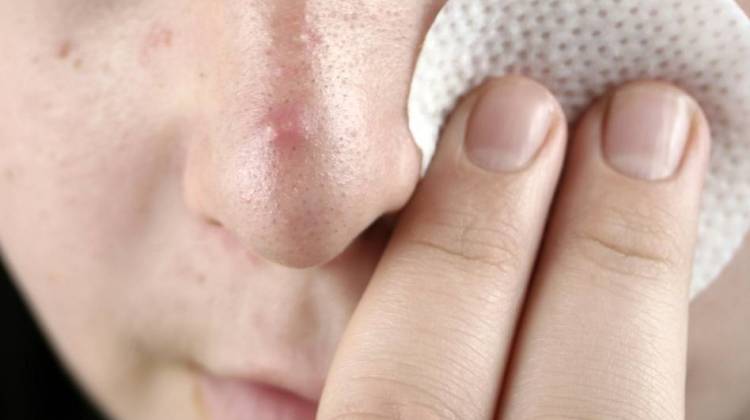 FDA Warns Of Life-Threatening Reactions With Acne Products