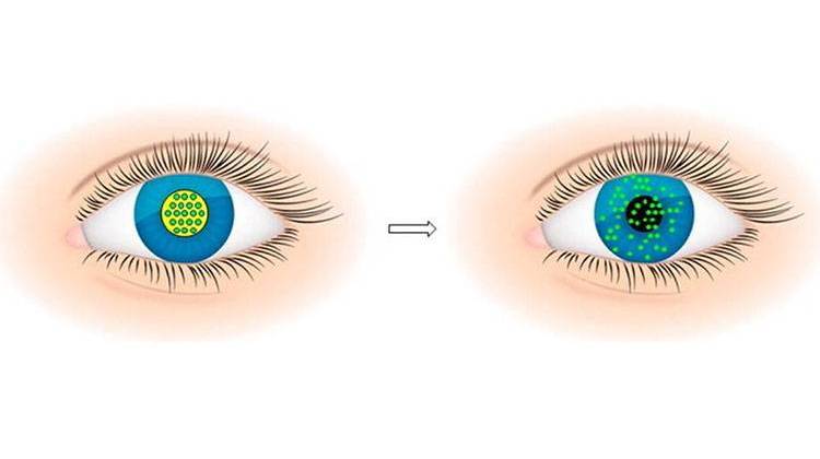 Dissolving Contact Lenses Could Make Eye Drops Disappear