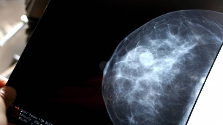 Review Finds Mammography's Benefits Overplayed, Harms Dismissed