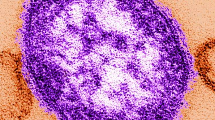 Is Indiana At Risk for Measles Outbreak?