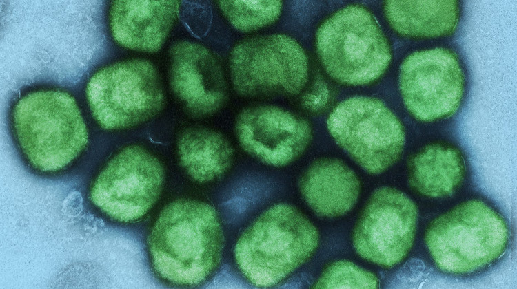 IU Health begins monkeypox testing at lab, cuts testing time