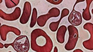 Experimental Malaria Vaccine Blocks The Bad Guy's Exit