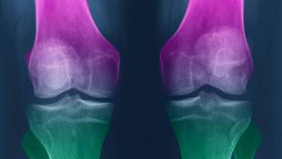 Exercise May Help Knees More Than Glucosamine And Chondroitin