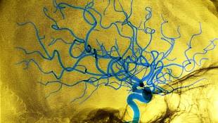 Most U.S. Women Wouldn't Know A Stroke If They Saw Or Felt One