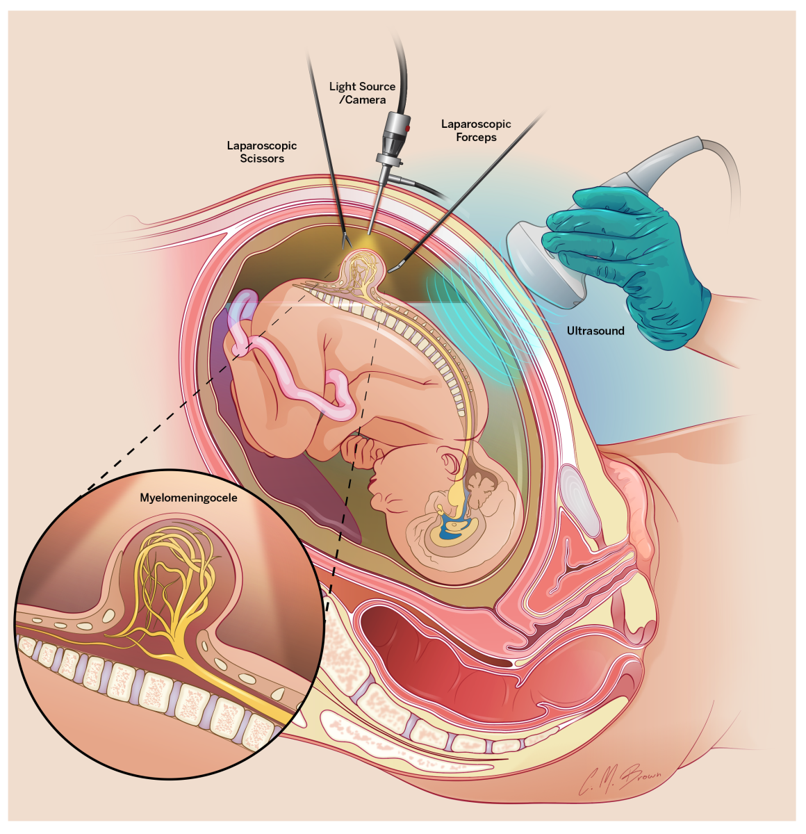 A look at the procedure performed by doctors at Riley Children’s Hospital