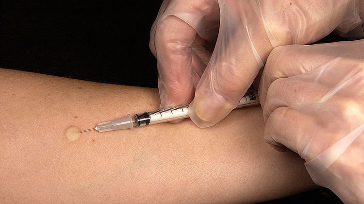 In this photo from the Centers for Disease Control and Prevention's Public Health Image Library, a technician places a tuberculin skin test in a recipient’s forearm. - Centers for Disease Control and Prevention