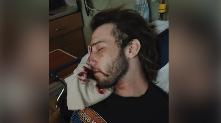 In this photo included in court documents, Balin Brake is in the hospital after being struck by a tear gas canister police fired during 2020 protests over the killing of George Floyd. - Court documents/brake-v-ftwayne-complaint