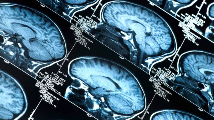 Concussions May Increase Alzheimer's Risk, But Only For Some
