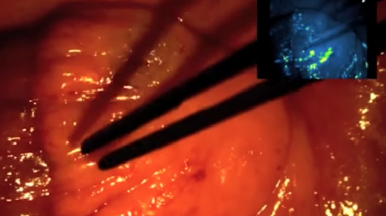 In the right hand corner, under fluorescent lamp, the cancerous tissue glows. - On Target Laboratories/YouTube