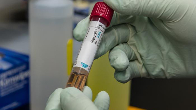 A test tube with viral transport media that contained a patient’s sample to be tested for the presence of SARS-CoV-2, the virus that causes COVID-19. - James Gathany/CDC