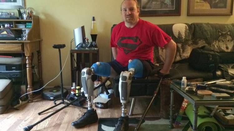 Friends Pitch In For Indy Man's High-Tech Legs