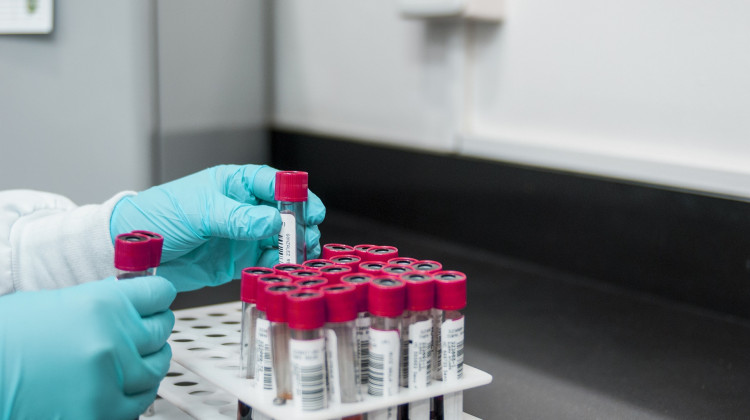 A simple blood test can detect colorectal cancer early, study finds