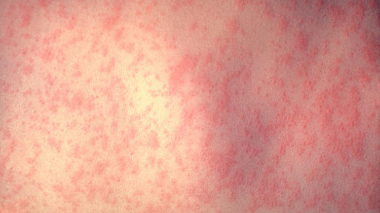 This photo from the CDC's Public Health Image Library shows skin of a patient after 3 days of measles infection. - CDC/Dr. Heinz F. Eichenwald