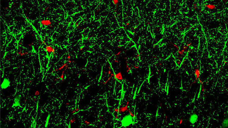 MicroRNA 142, in green, shown in neurons in the brain. The molecule may represent a potential biomarker to diagnose or predict dementia. -  (Photo courtesy of Hui-Chen Lu/Indiana University)