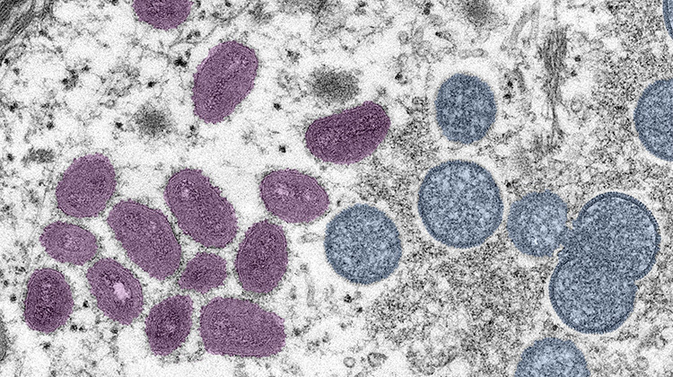 This digitally-colorized electron microscopic (EM) image from the Centers for Disease Control and Prevention shows monkeypox virus particles. On the left are mature, oval-shaped virus particles, and on the right are the crescents and spherical particles of immature virions. - Centers for Disease Control and Prevention