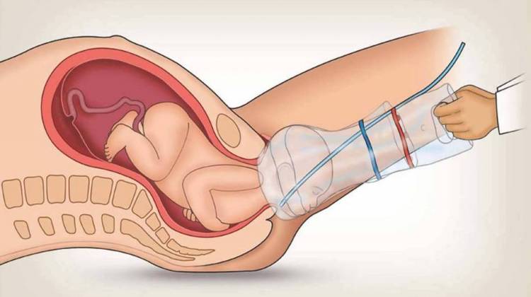 Popping A Baby Out Like A Cork, And Other Birth Innovations