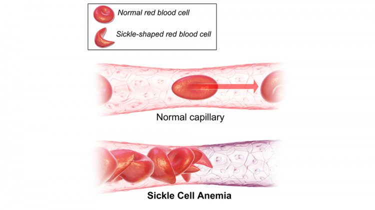 Local Medical Center Gets CDC Grant To Collect Sickle Cell Data