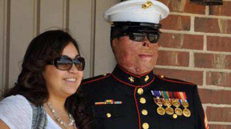 Severely Burned Marine Finds Strength In Nascent Marriage