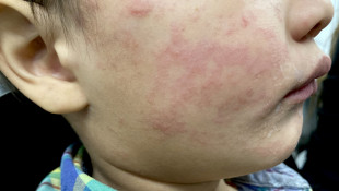 Health officials warn spring break travelers about rise in measles